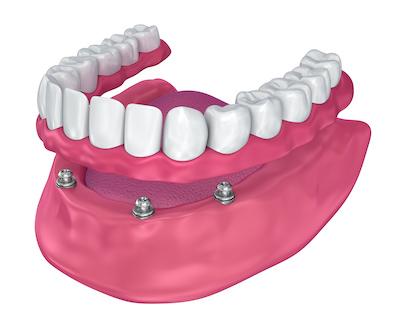 dental implant bridge on bottom jaw | dental implants poipu