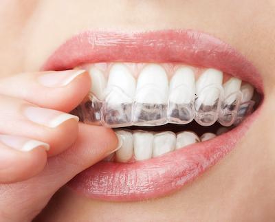 A woman putting on her Invisalign clear aligners