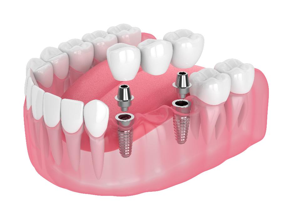 close up of implants in jaw | dental implants kauai