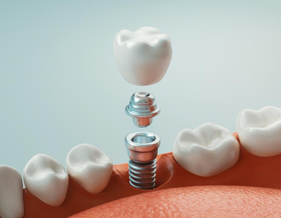close up of dental implant in 3 parts | dental implants kaui