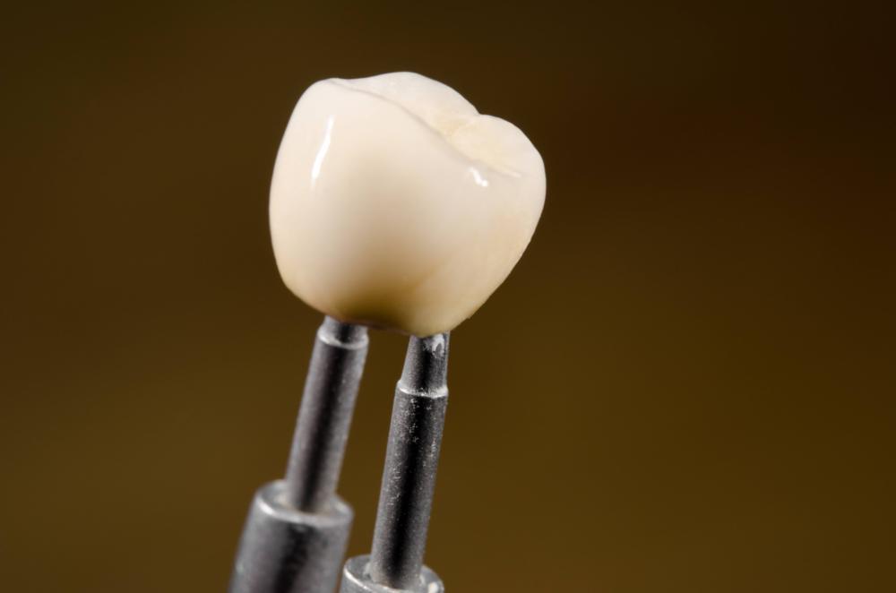 Dental Crowns | Kalaheo Dental Group | Kalaheo, HI