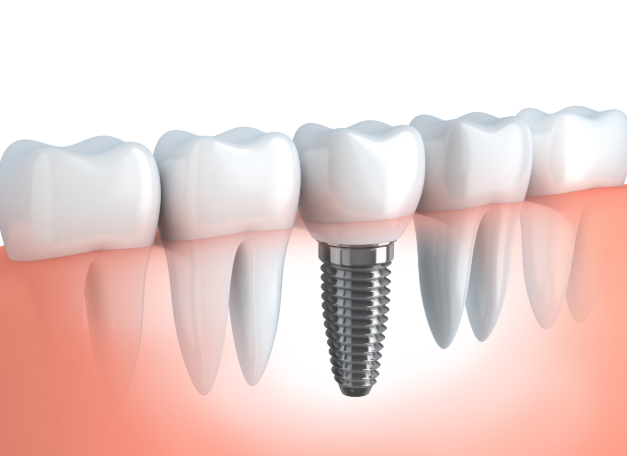 Diagram of Dental Implant & Titanium Root