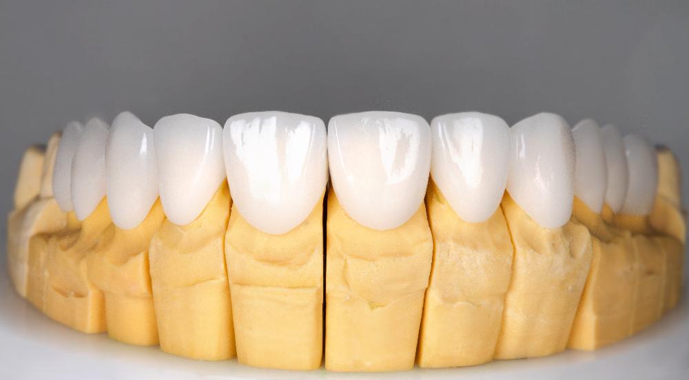 close up of jaw with veneers | veneers kalaheo