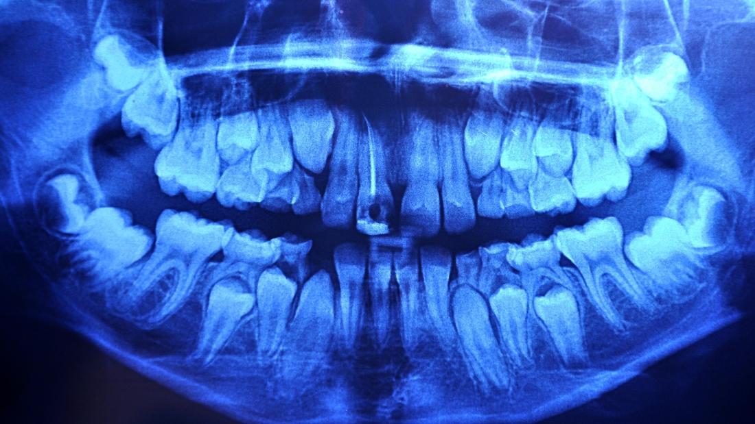 Abscessed Wisdom Tooth Xray