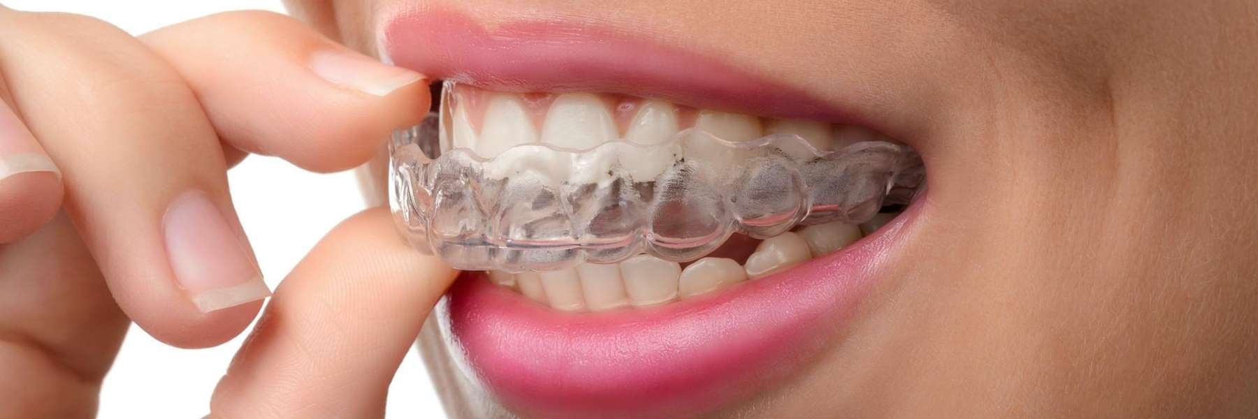 patient putting in clear plastic aligner | cosmetic dentist kauai