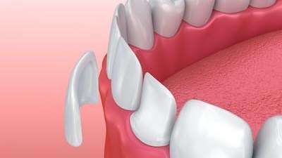 Diagram of veneers in Kauai