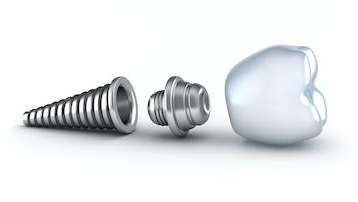 dental implant in three parts | dental implants poipu