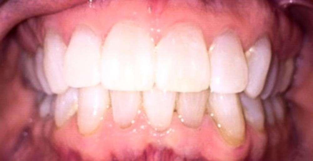 teeth after invisalign and teeth whitening in Kalaheo, HI
