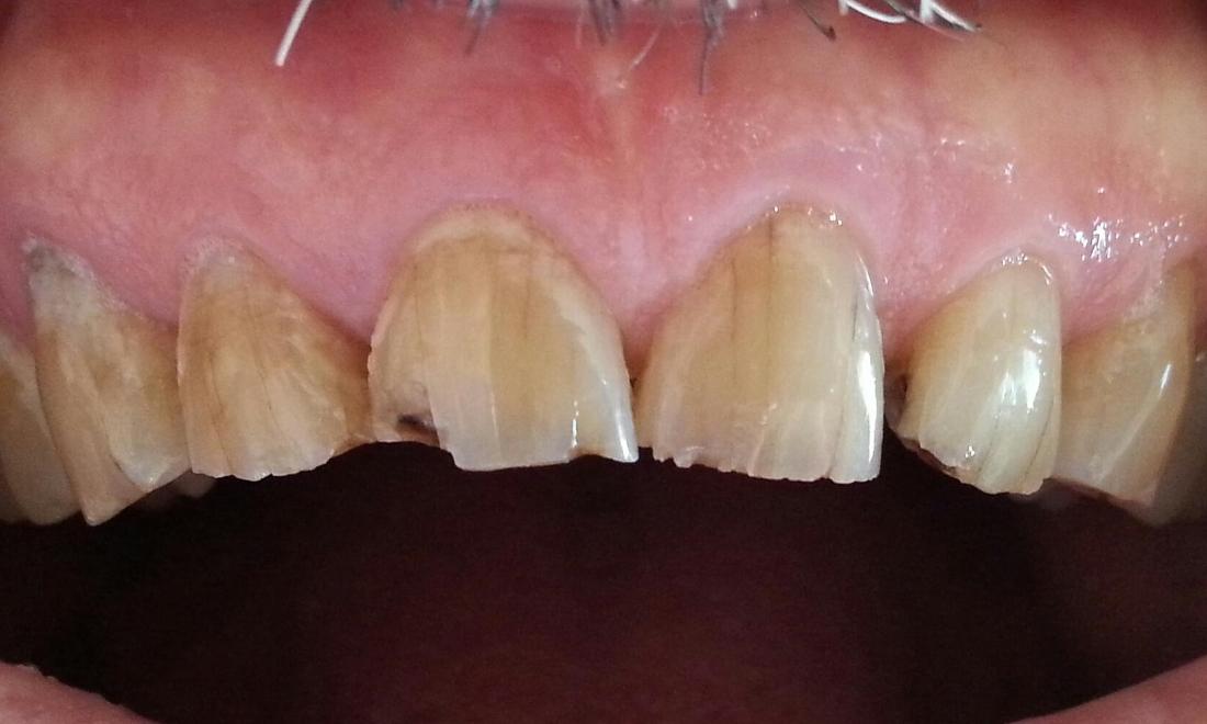 Worn down chipped teeth before | Kalaheo Dental Group | Kalaheo, HI