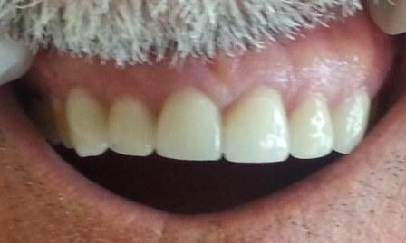 Porcelain Crowns and Veneers | Kalaheo Dental Group | Kalaheo, HI