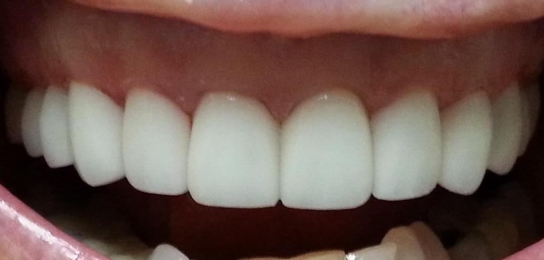 Whitened and straightened teeth | Kalaheo Dental Group | Kalaheo, HI