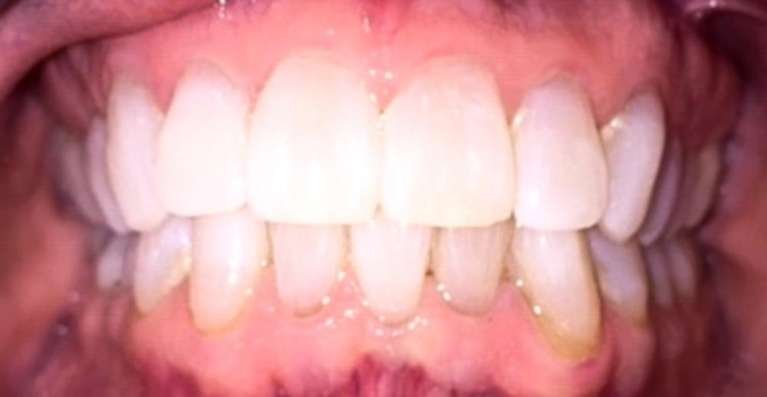 teeth after invisalign and teeth whitening in Kalaheo, HI