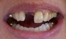 Missing front tooth | Kalaheo Dental Group | Kalaheo, HI