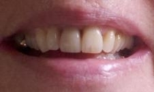 Replaced Front Teeth | Kalaheo Dental Group | Kalaheo, HI