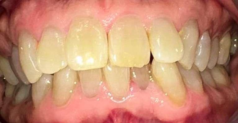 teeth before invisalign and teeth whitening in Kalaheo, HI