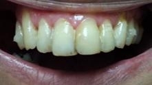 Crowded and stained teeth before | Kalaheo Dental Group | Kalaheo, HI