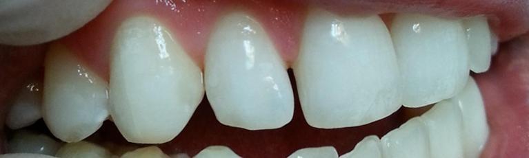 Spaces in front teeth | Kalaheo Dental Group | Kalaheo, HI