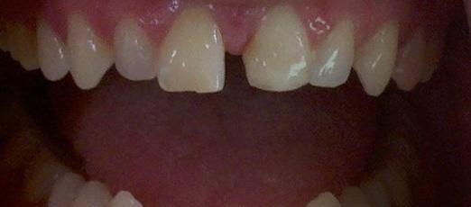 Chipped and cracked teeth | Kalaheo Dental Group | Kalaheo, HI