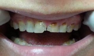 Porcelain-Crowns-Before-and-After-Before-Image