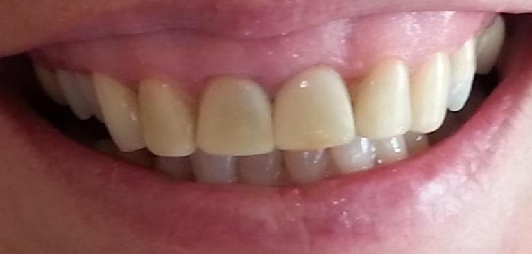 Stained and worn down teeth before | Kalaheo Dental Group | Kalaheo, HI