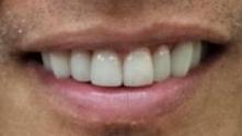 Straightened teeth after | Kalaheo Dental Group | Kalaheo, HI