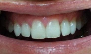 Crowded teeth before | Kalaheo Dental Group | Kalaheo, HI