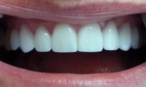 Veneers after | Kalaheo Dental Group | Kalaheo, HI