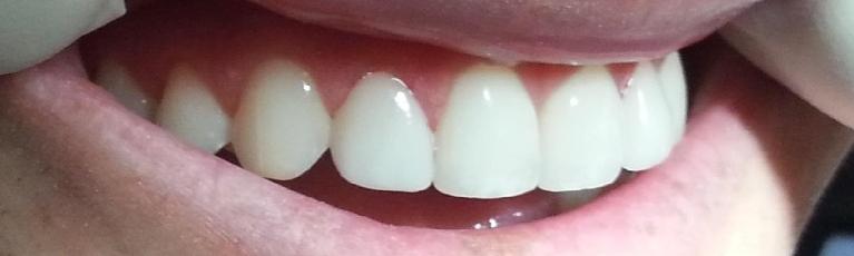 Straightened teeth after | Kalaheo Dental Group | Kalaheo, HI