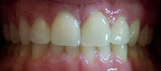 Veneers and porcelain crowns after | Kalaheo Dental Group | Kalaheo, HI
